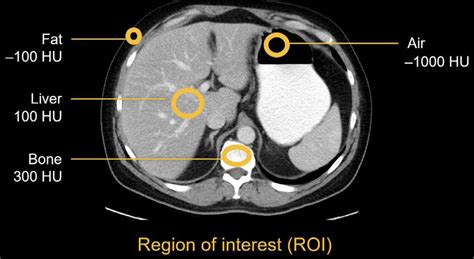 Abdominal Ct Attenuation Litfl Radiology Library