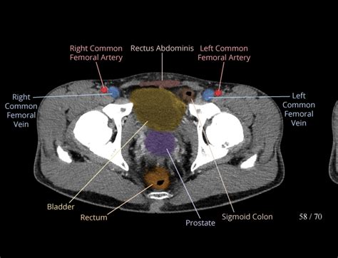 Labelled Female Ct Scan Abdomen At Rosario Miesner Blog